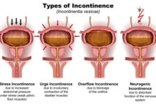 3D digital urinary incontinence diagram