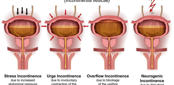 3D digital urinary incontinence diagram