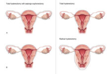 3D rendered illustration of the types of hysterectomy