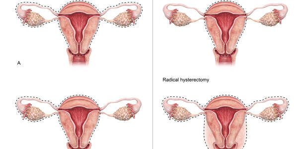 3D rendered illustration of the types of hysterectomy